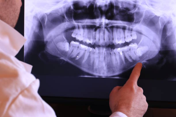 Best Emergency Wisdom Teeth Removal in Oak Grove, SC
